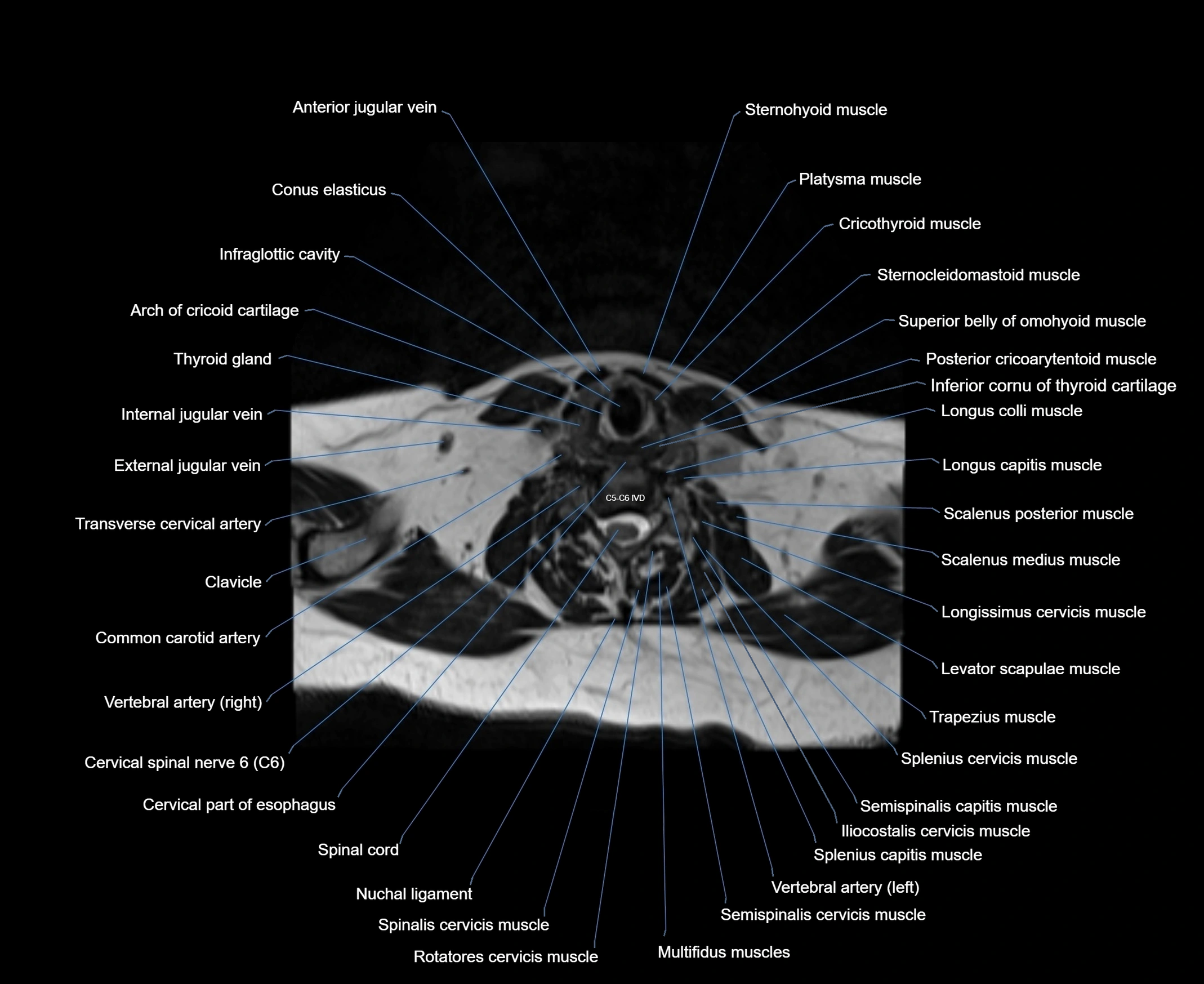 MRI Neck 3D labelled cross section anatomy axial 3t image-00001-00065.webp